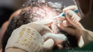 Durch eine Haartransplantation lassen sich kahle Stellen dauerhaft verdichten