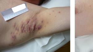 Vorher-Nachher-Effekt einer lAight-Therapie an der Achsel