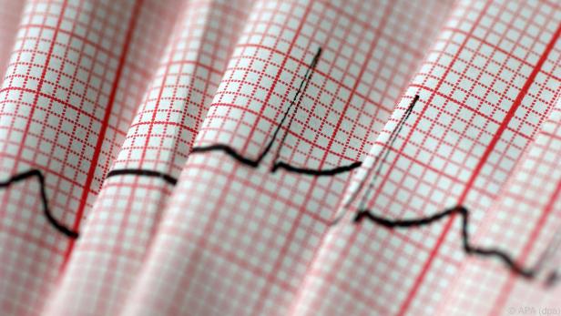 Der EKG-Ausdruck macht die Aktivität des Herzens sichtbar