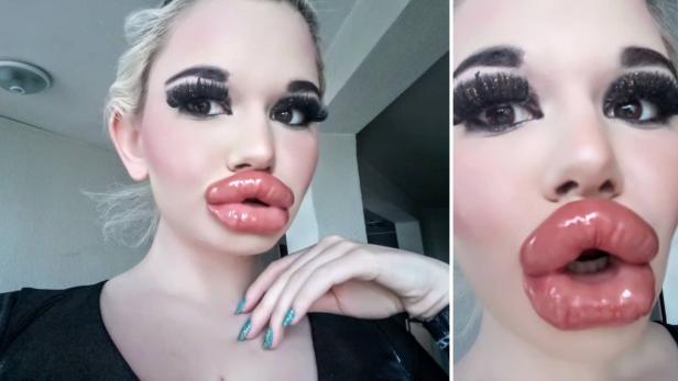 Diese Frau will die größten Lippen der Welt