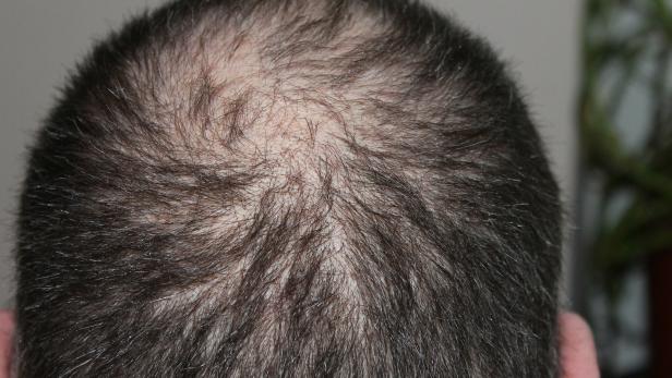 Studie: Männer streiten Haarausfall ab
