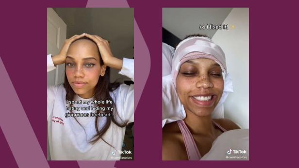 Dieses Model geht mit einer Stirnverkleinerung viral