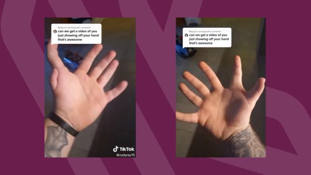 Dieser TikToker hat zwölf Finger – und begeistert das Netz