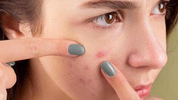 Pickel richtig ausdrücken: Dermatologen-Tipps mit Video-Anleitung